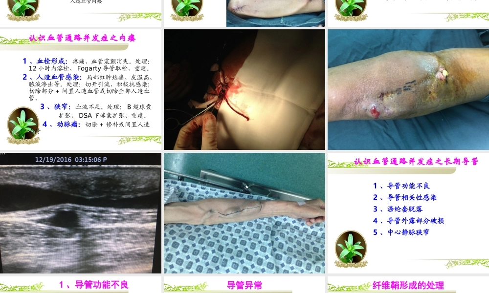 血管通路简介及水处理的重要性.ppt