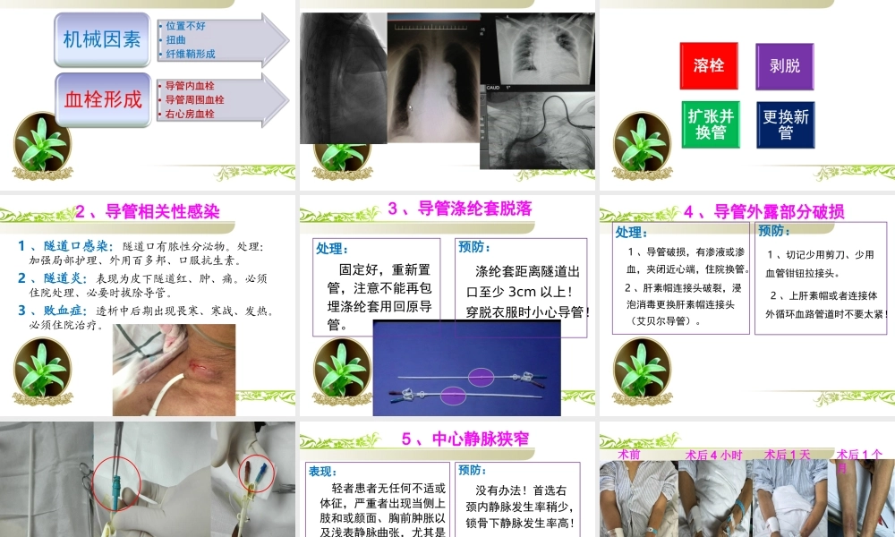 血管通路简介及水处理的重要性.ppt