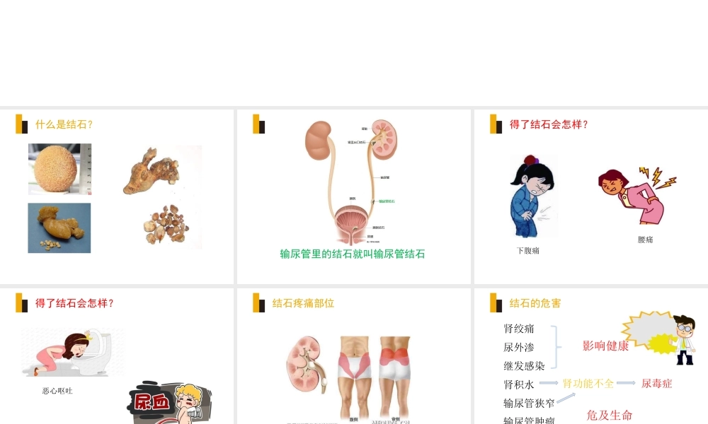 输尿管镜钬激光碎石宣教.ppt