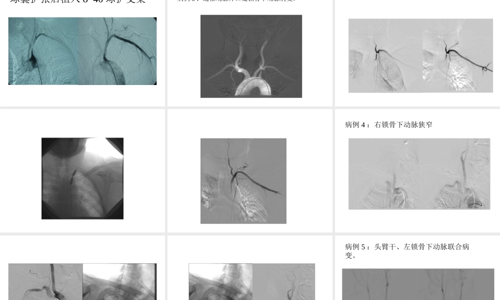 锁骨下动脉狭窄与闭塞的血管腔内.ppt