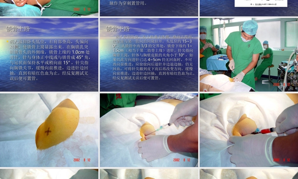 锁骨下静脉穿刺jmcczgjsdlcyy.ppt