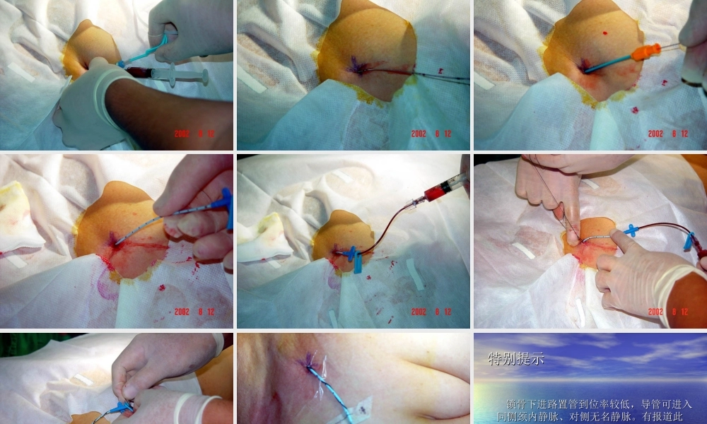 锁骨下静脉穿刺jmcczgjsdlcyy.ppt