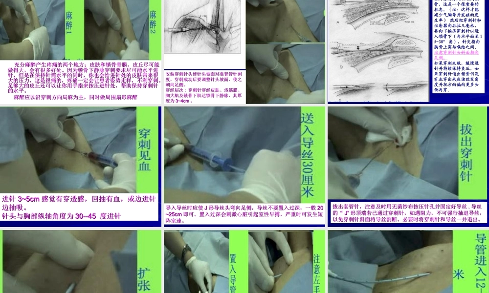 锁骨下静脉穿刺置管技术.ppt