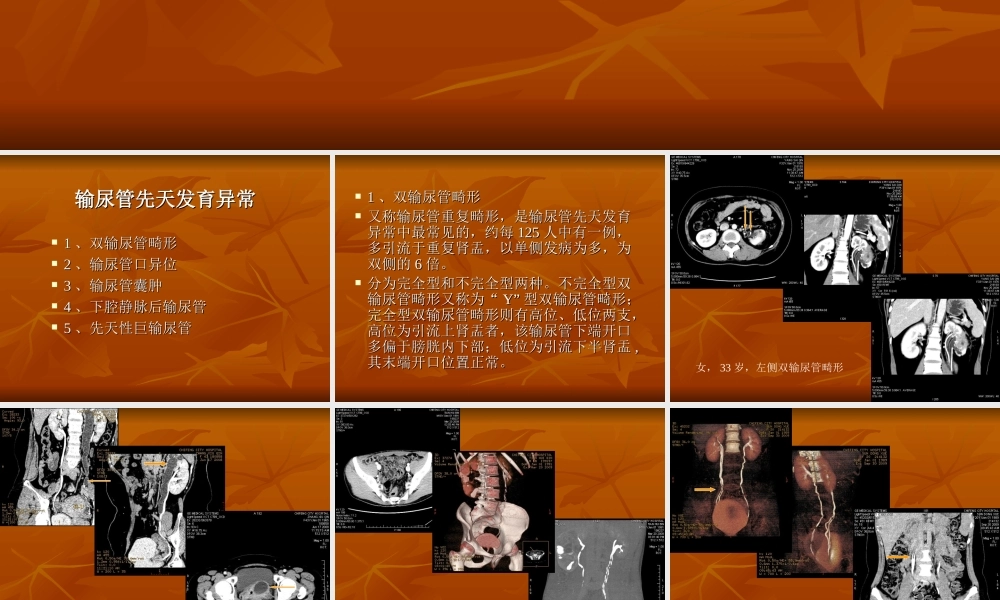 输尿管及膀胱先天异常.ppt