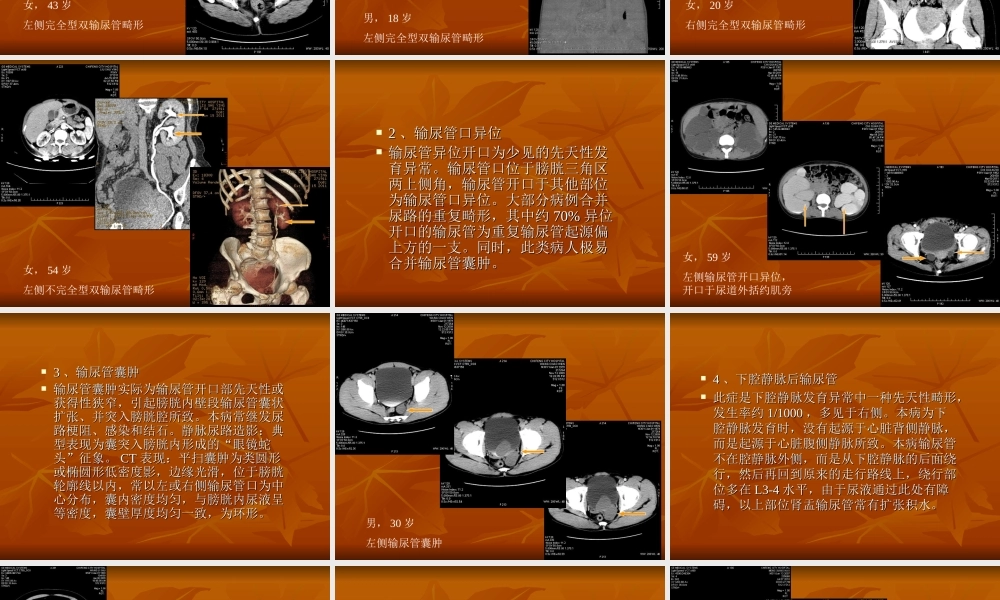 输尿管及膀胱先天异常.ppt