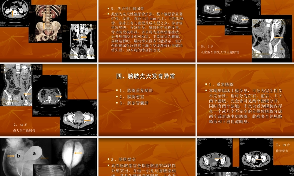 输尿管及膀胱先天异常.ppt