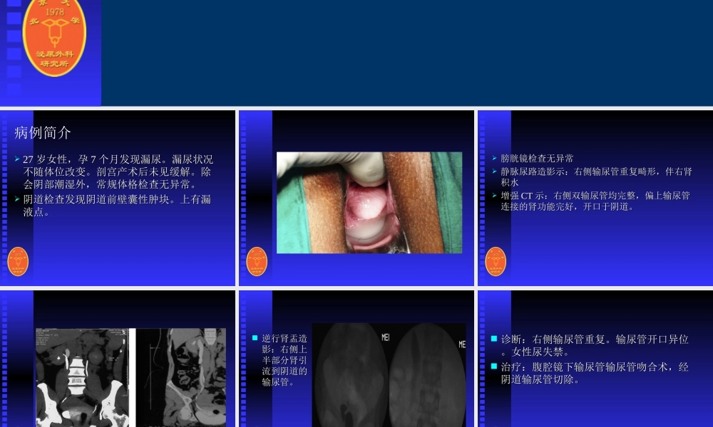 输尿管畸形引起的女性尿失禁.ppt