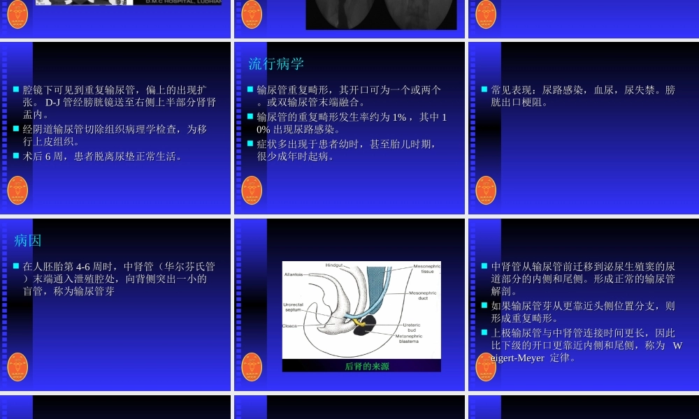 输尿管畸形引起的女性尿失禁.ppt