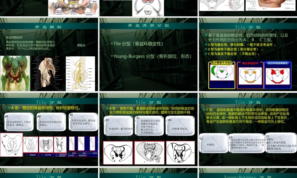 血流动力学不稳定骨盆骨折急诊处理.pptx