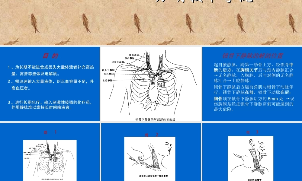 锁骨下静脉穿刺置管术修改后.ppt