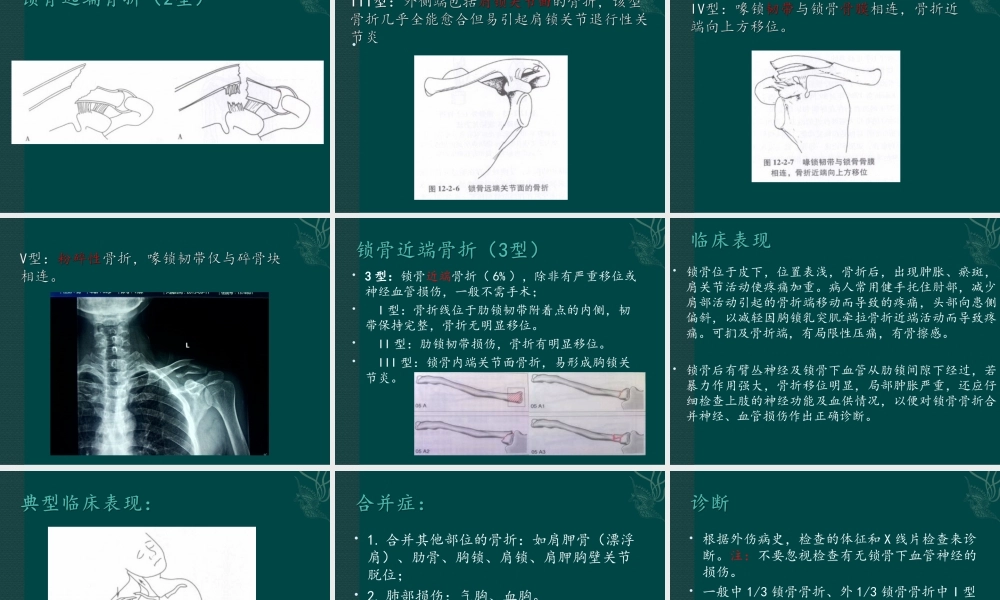 锁骨骨折.ppt