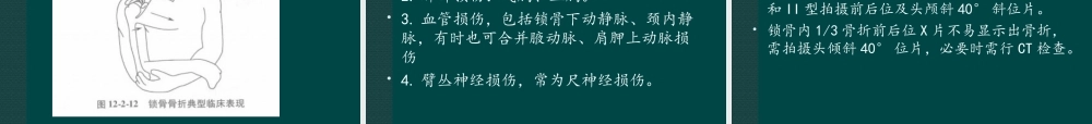 锁骨骨折.ppt