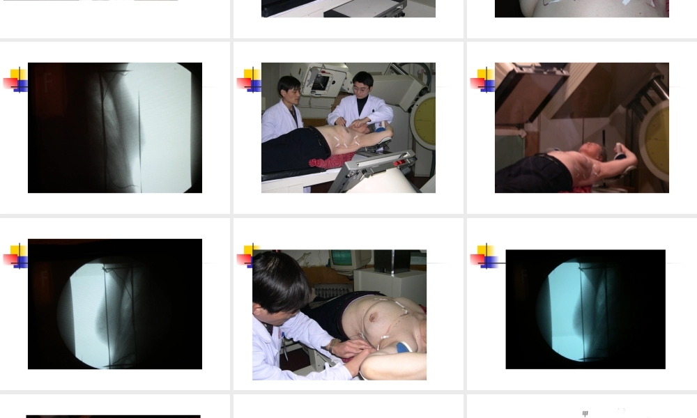 乳腺癌照射技术-余子豪.ppt