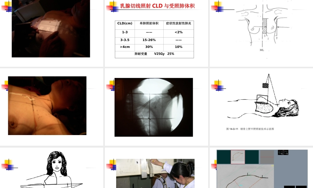 乳腺癌照射技术-余子豪.ppt
