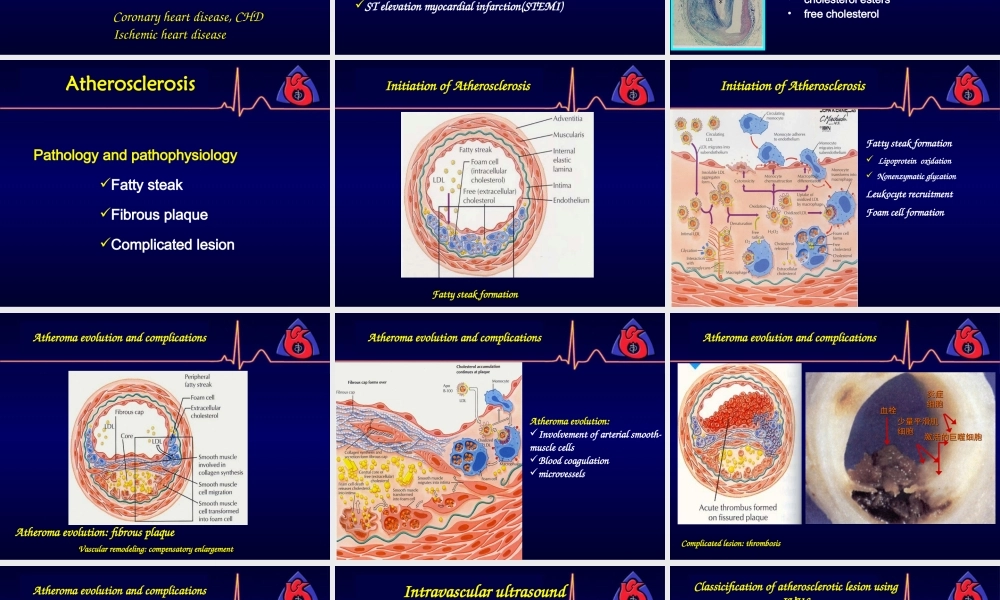 冠心病英文版.ppt