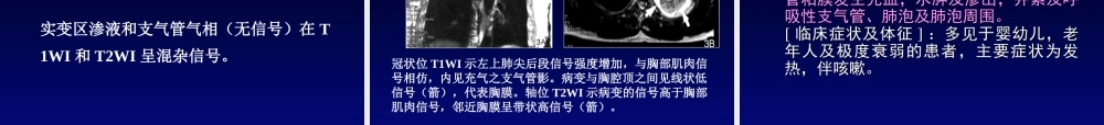 呼吸系统MRI(影像).ppt
