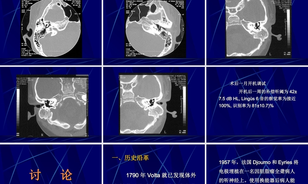 人工耳蜗植入概要.ppt