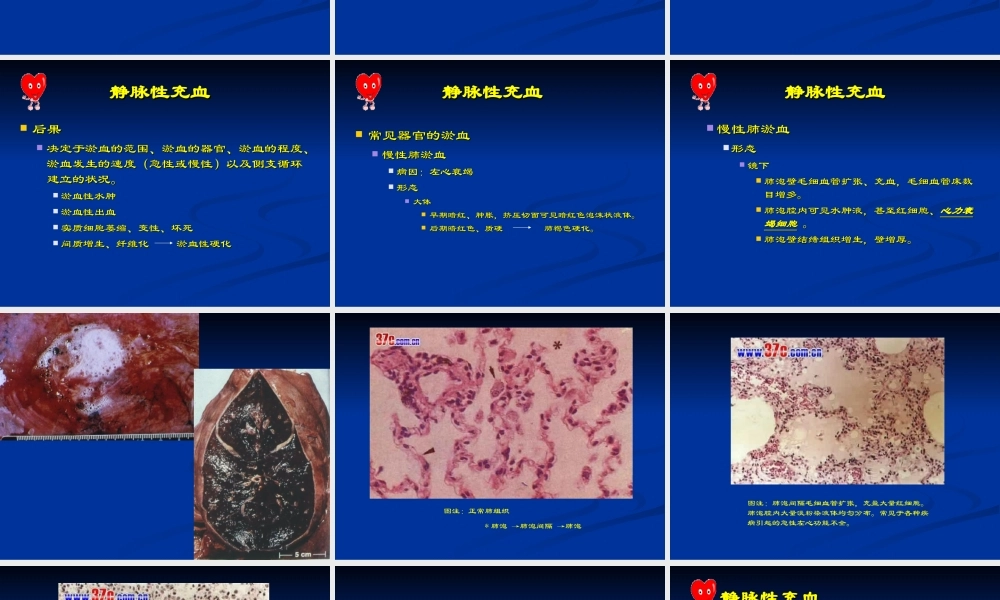 Chapter-3-血液循环障碍.ppt