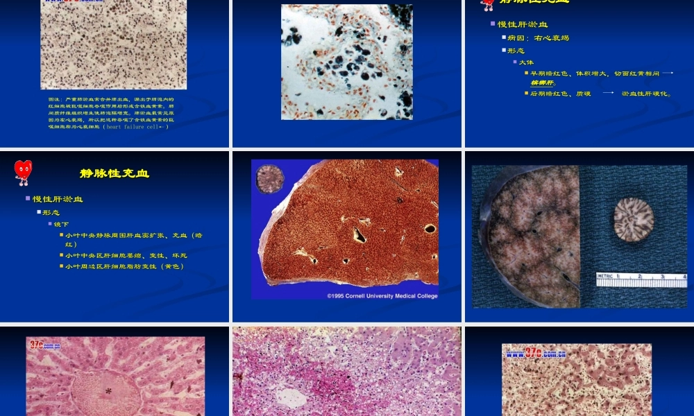 Chapter-3-血液循环障碍.ppt