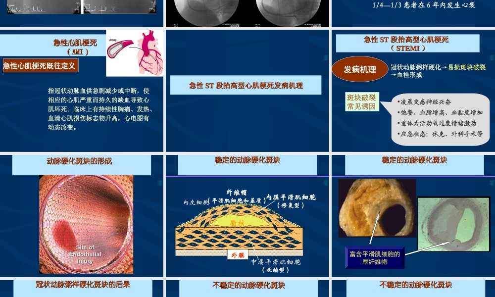 急性心肌梗死的紧急救治.ppt