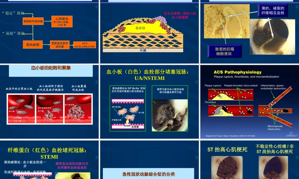 急性心肌梗死的紧急救治.ppt