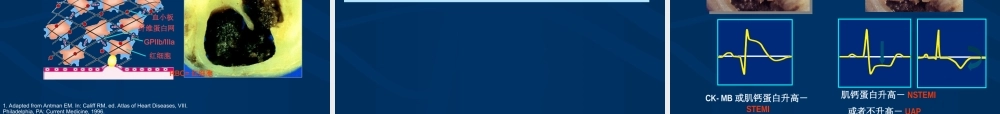急性心肌梗死的紧急救治.ppt