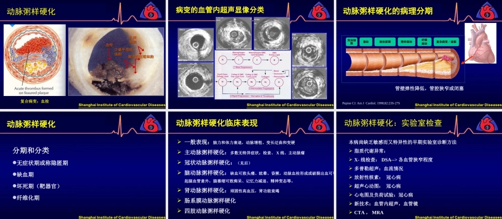 动脉粥样硬化和冠状动脉粥样硬化性心脏病.ppt