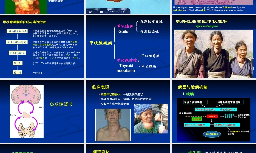 甲状腺-糖尿病-cjz.ppt