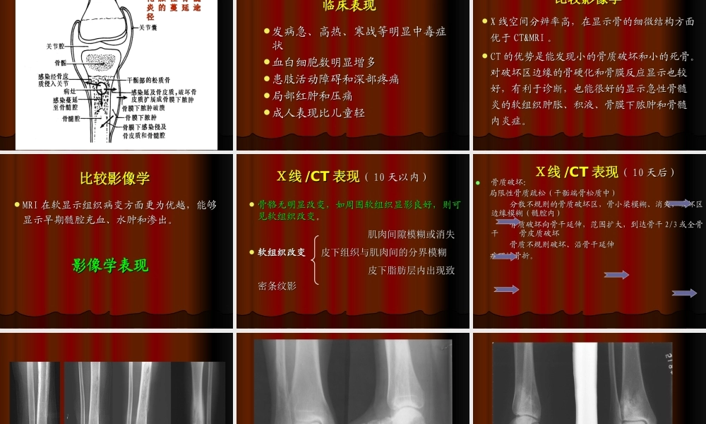 影像——骨关节化脓性感染.ppt