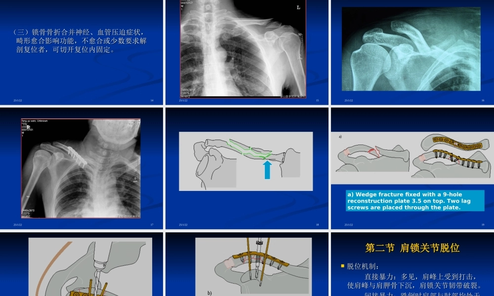 507上肢骨、关节损伤1.ppt