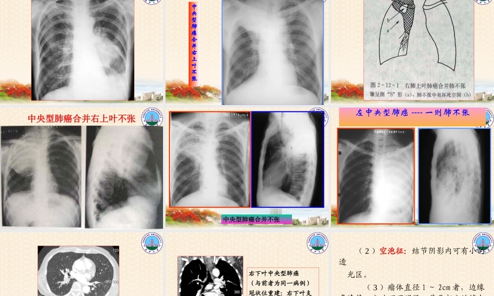呼吸系统2(影像-).ppt