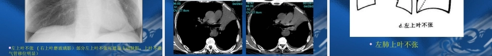 呼吸系统常见病变的影像学表现.ppt