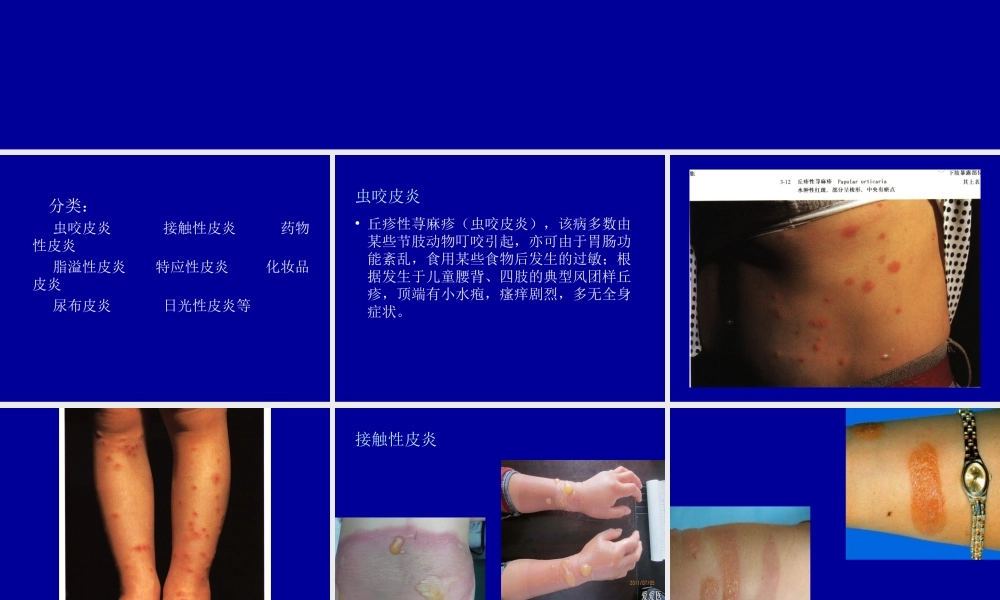 常见皮炎介绍模板.ppt