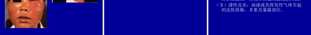 常见皮炎介绍模板.ppt