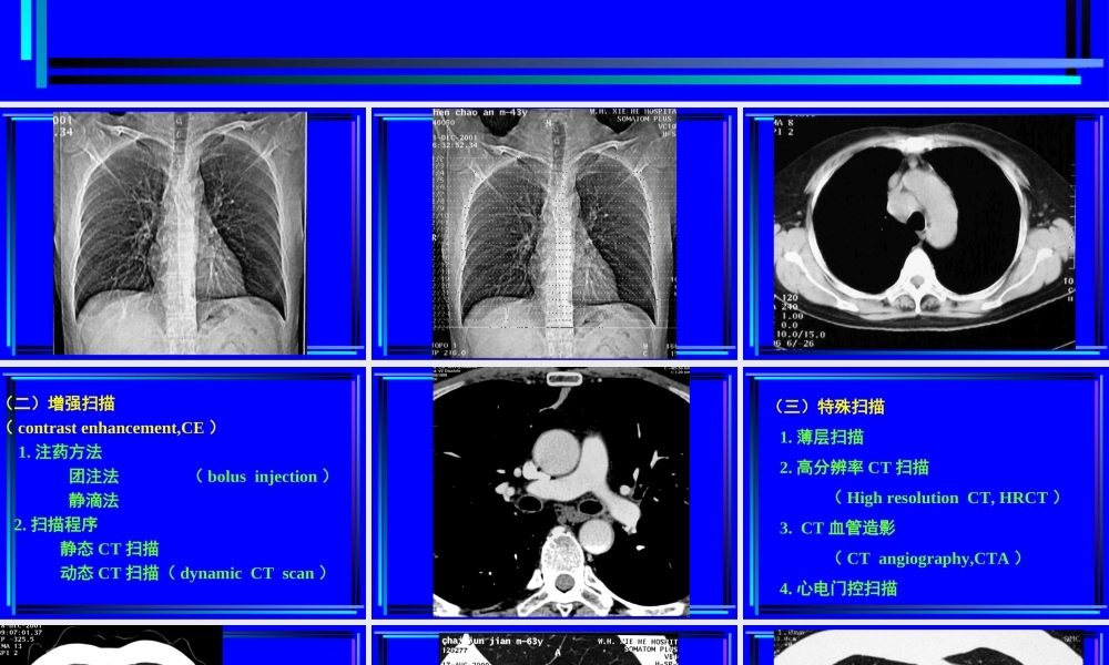 住院医师胸部CT诊(超量实例CT片).ppt