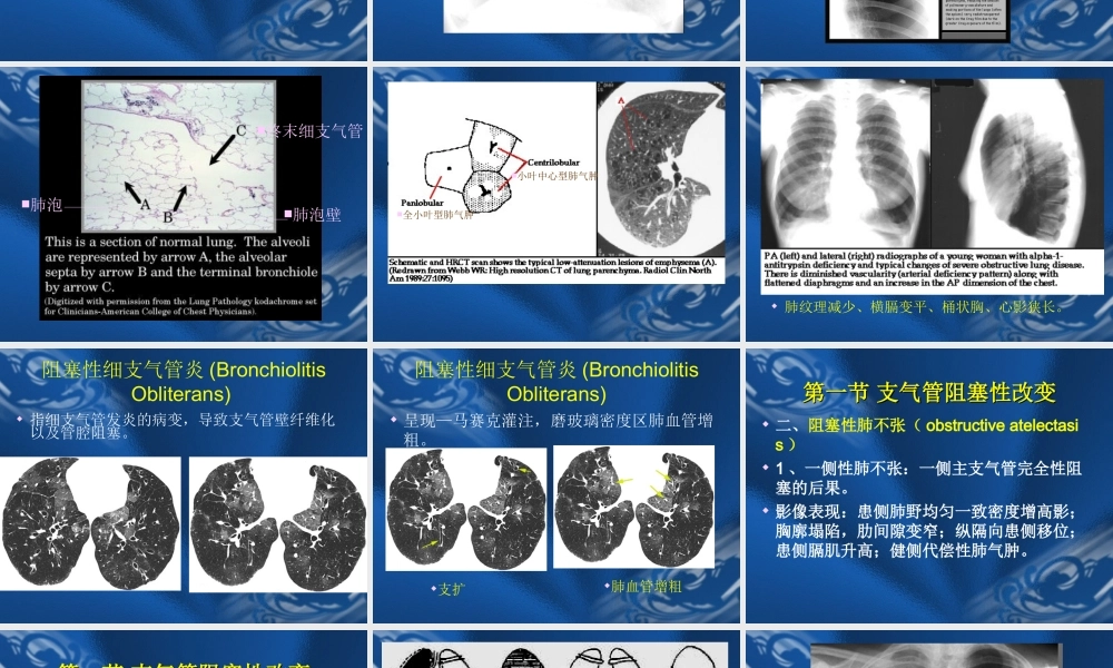 呼吸系统基本病变的影像学改变.ppt