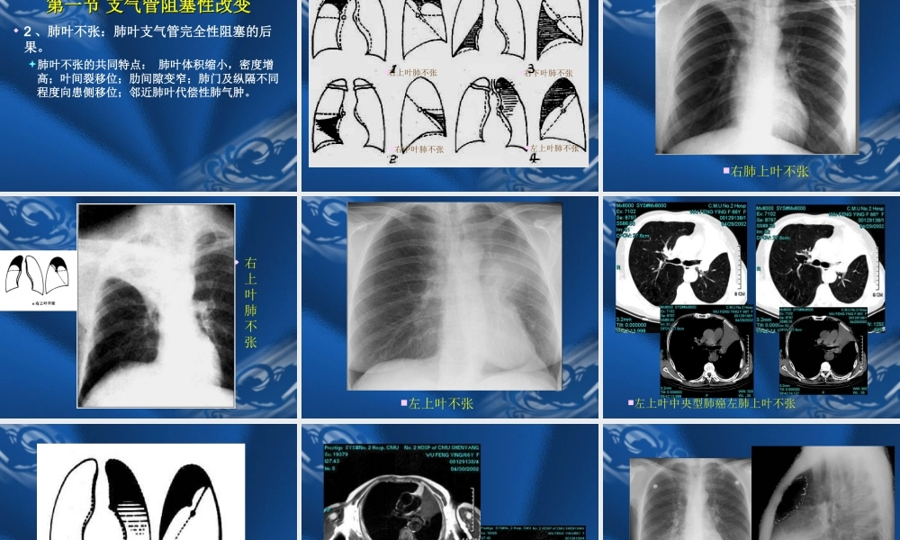 呼吸系统基本病变的影像学改变.ppt