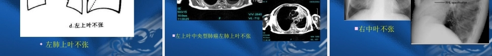 呼吸系统基本病变的影像学改变.ppt
