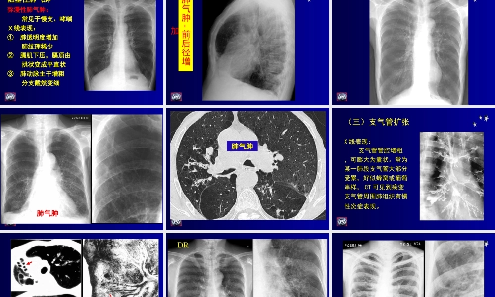 影像学-呼吸基础病变.ppt