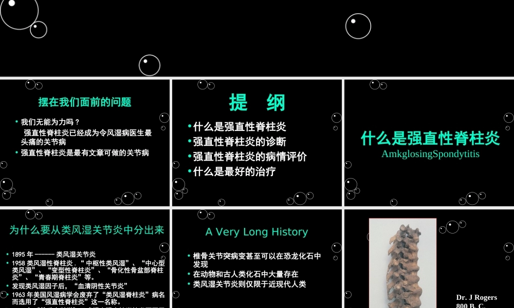 强直性脊柱炎x.ppt
