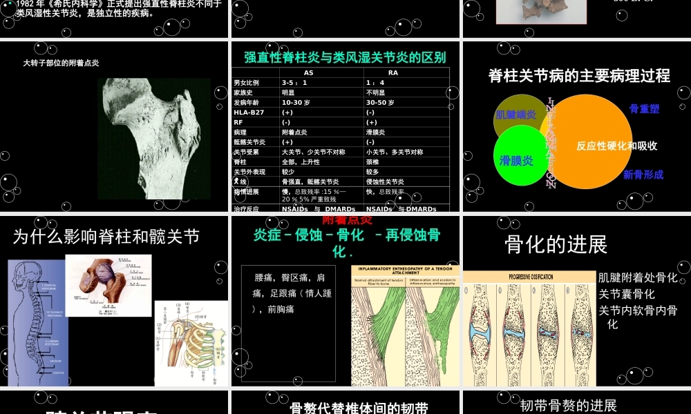 强直性脊柱炎x.ppt