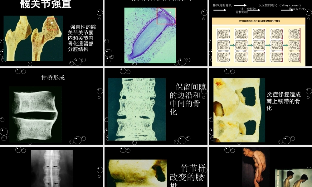 强直性脊柱炎x.ppt