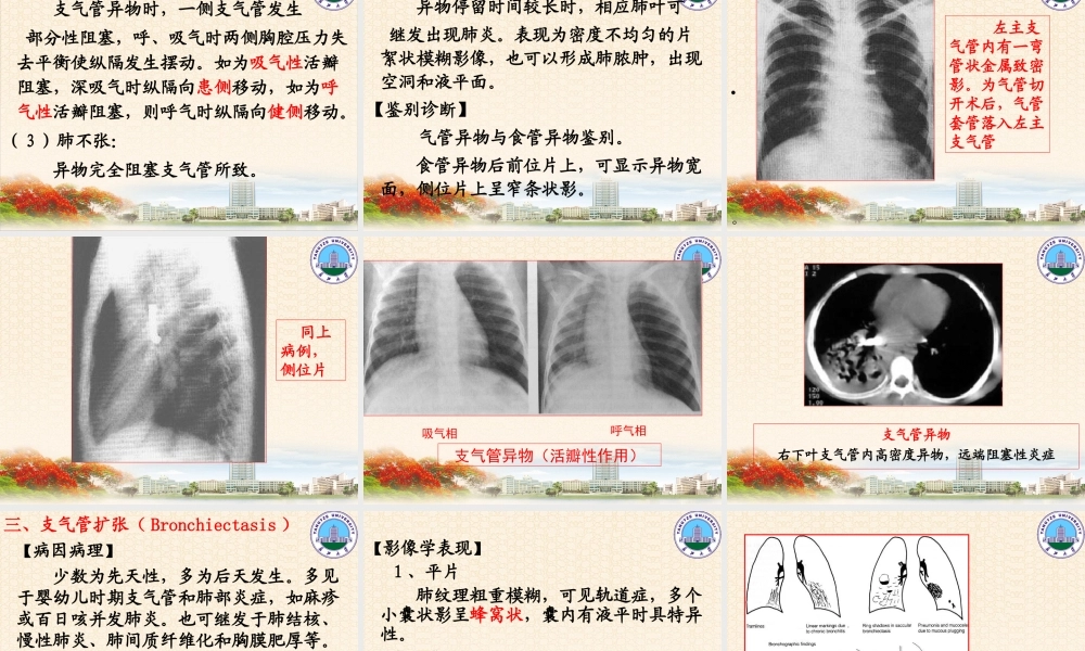 呼吸系统1(影像).ppt
