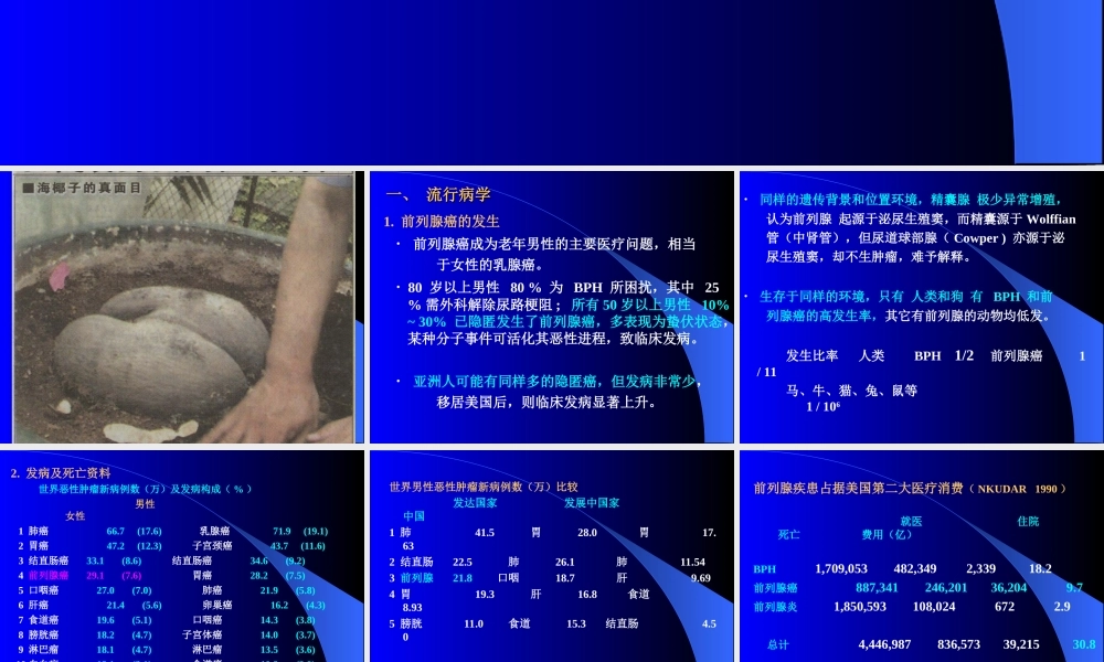 前列腺癌-刘新帆.ppt