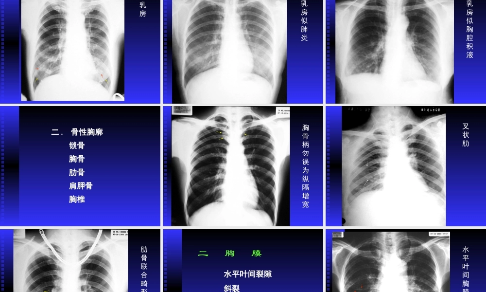 正常胸部影像学PPT.ppt