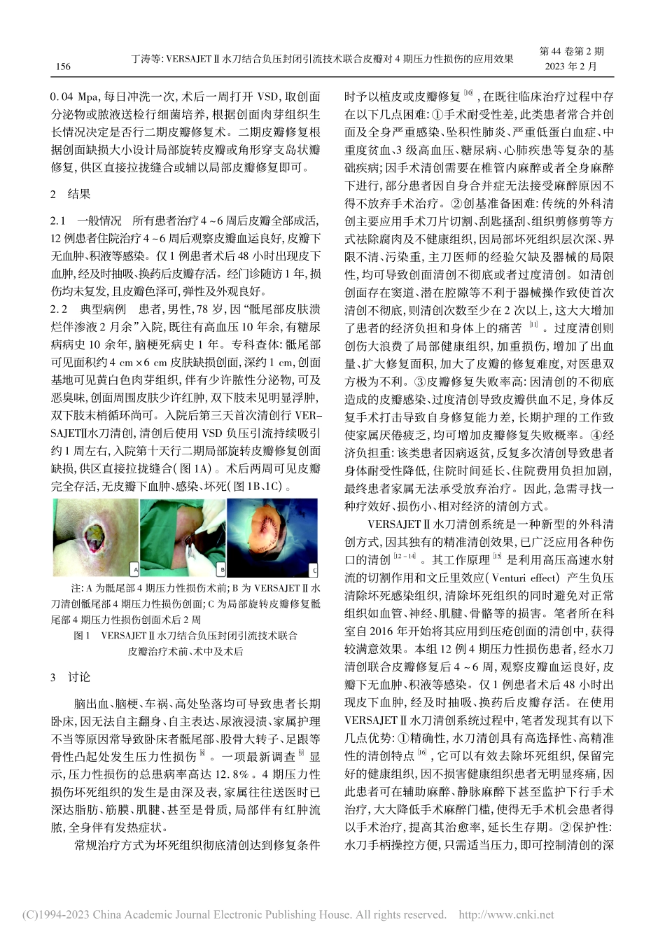 VERSAJETⅡ水刀结合...对4期压力性损伤的应用效果_丁涛.pdf_第2页