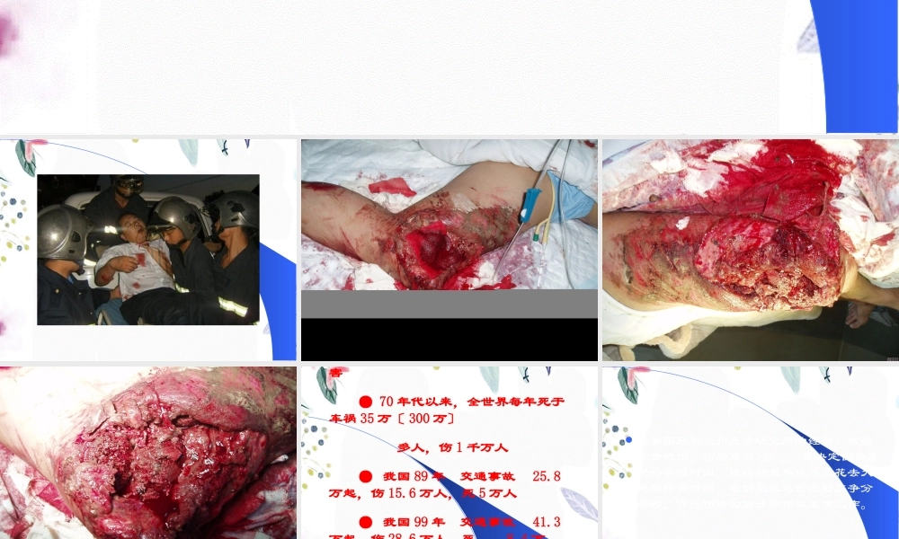 2023年多发伤的急救（教学课件）.ppt