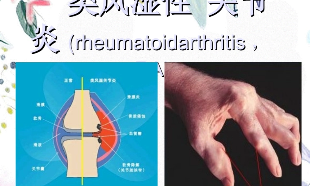 2023年类风湿性关节炎SLE（教学课件）.ppt