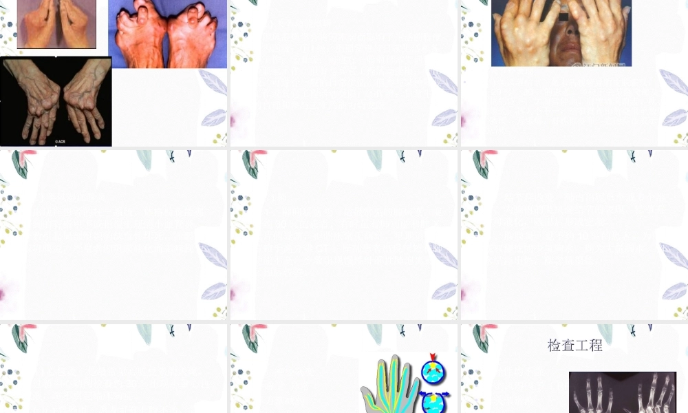 2023年类风湿性关节炎SLE（教学课件）.ppt