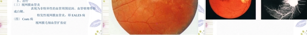 2023年视网膜病（教学课件）.ppt